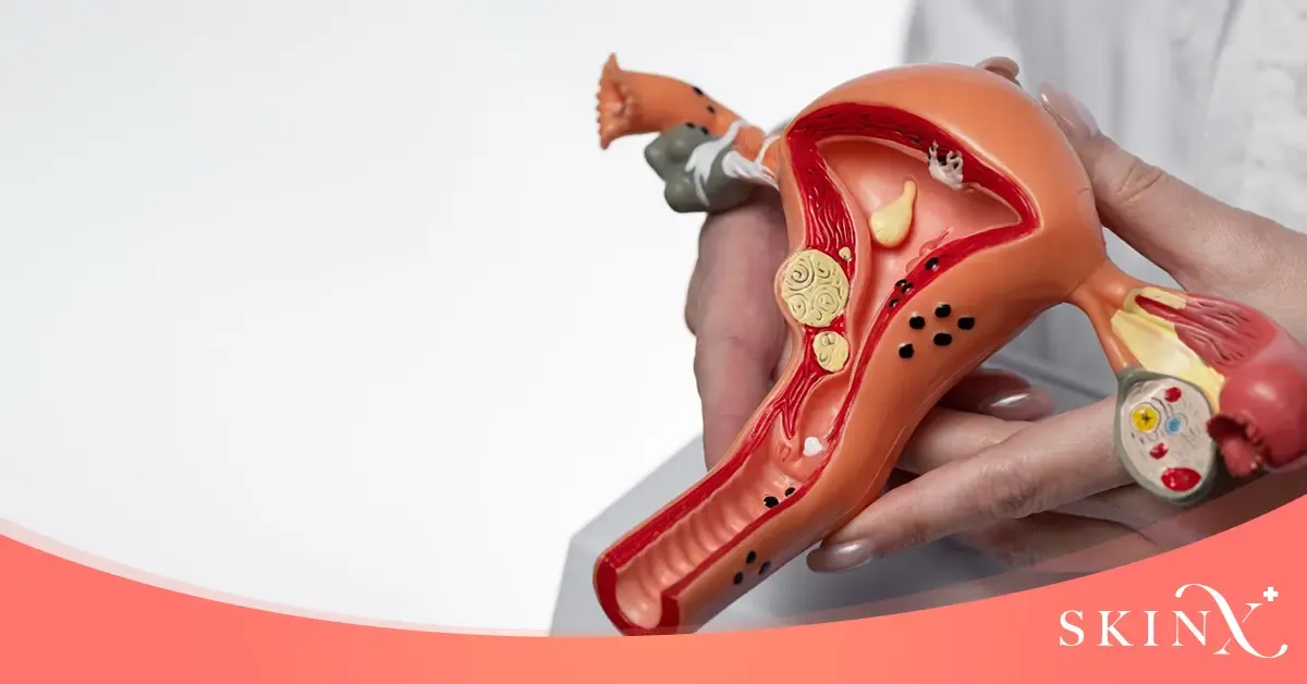 PCOS คืออะไร