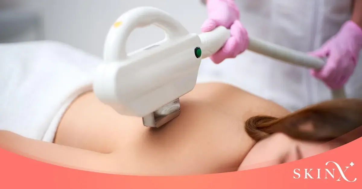 เลเซอร์รอยสิวหลัง