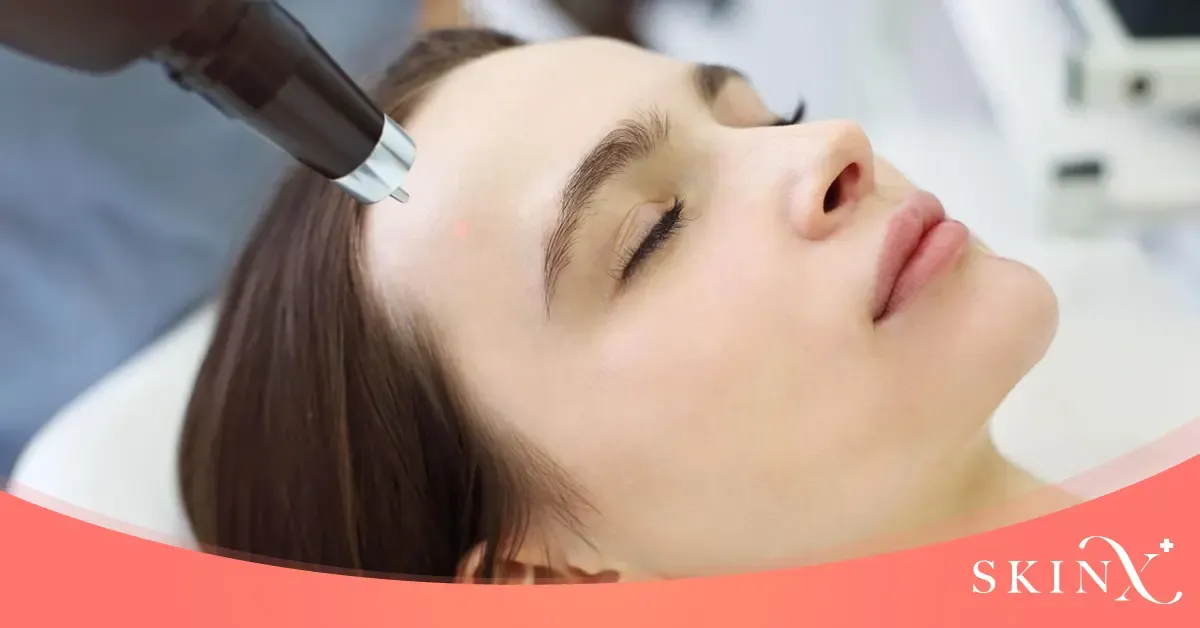 เลเซอร์หลุมสิว กี่ครั้งหาย