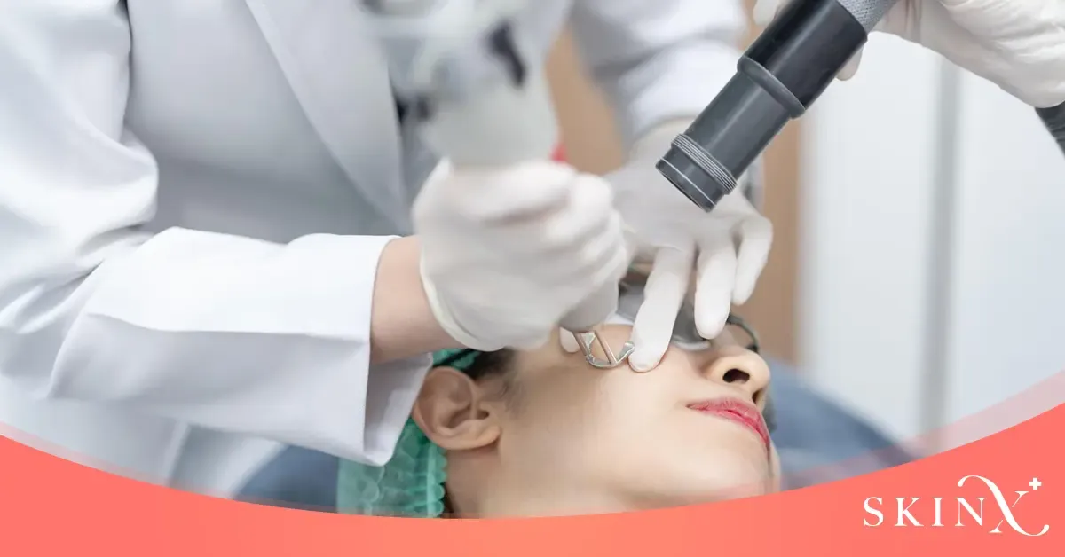 หลุมสิว-เลเซอร์