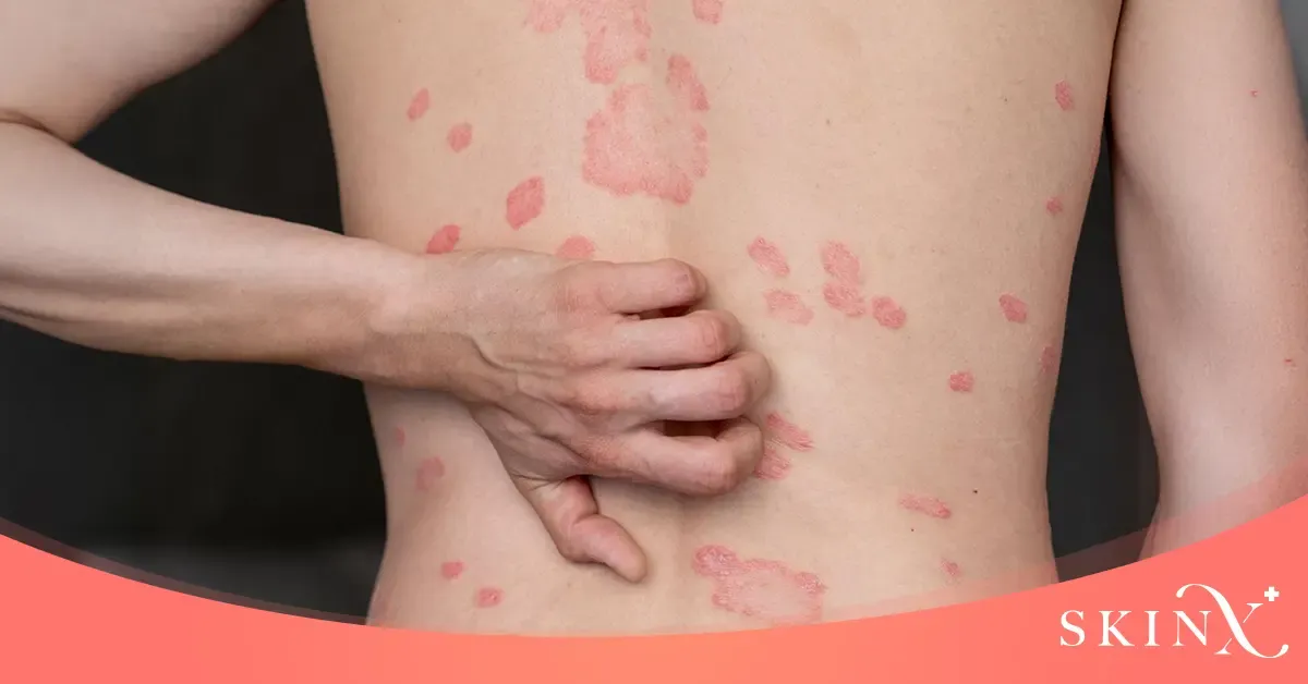 ผื่นกลีบกุหลาบเกิดจากอะไร