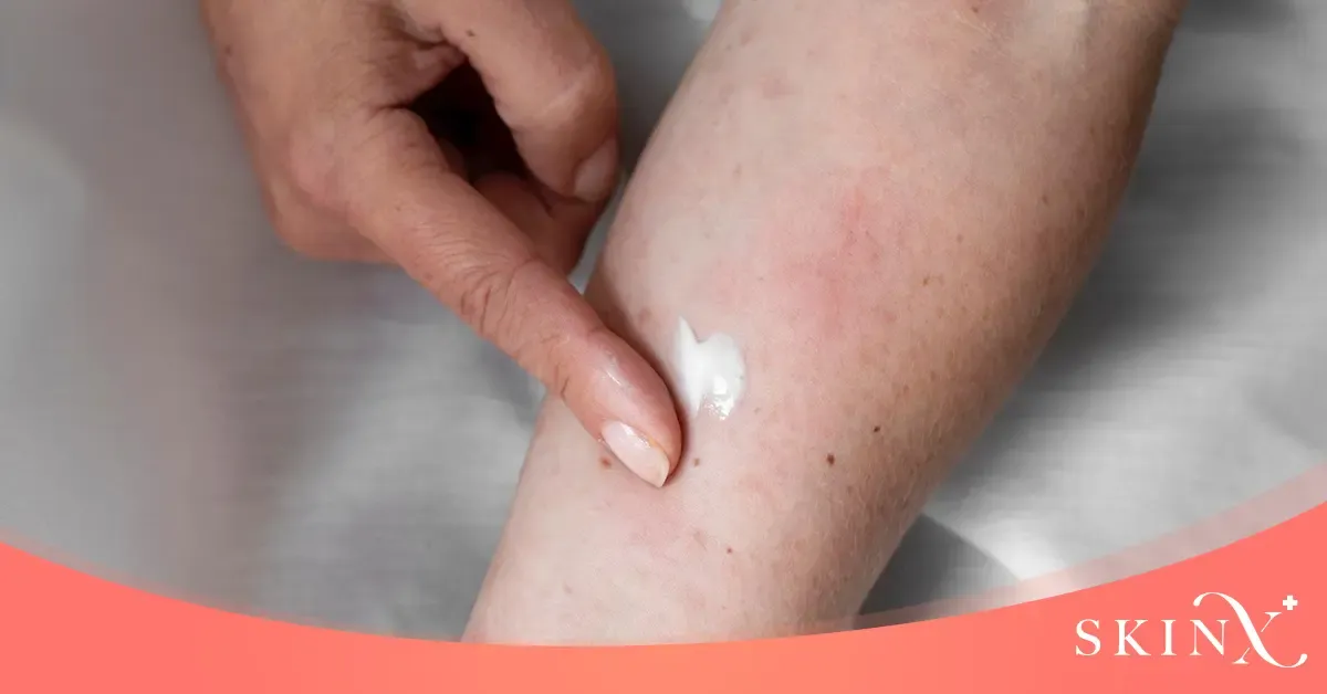 ผื่นกุหลาบ วิธีรักษา