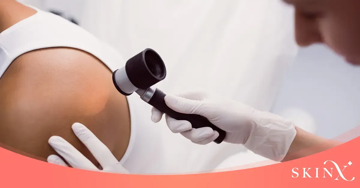 seborrheic keratosis คือ
