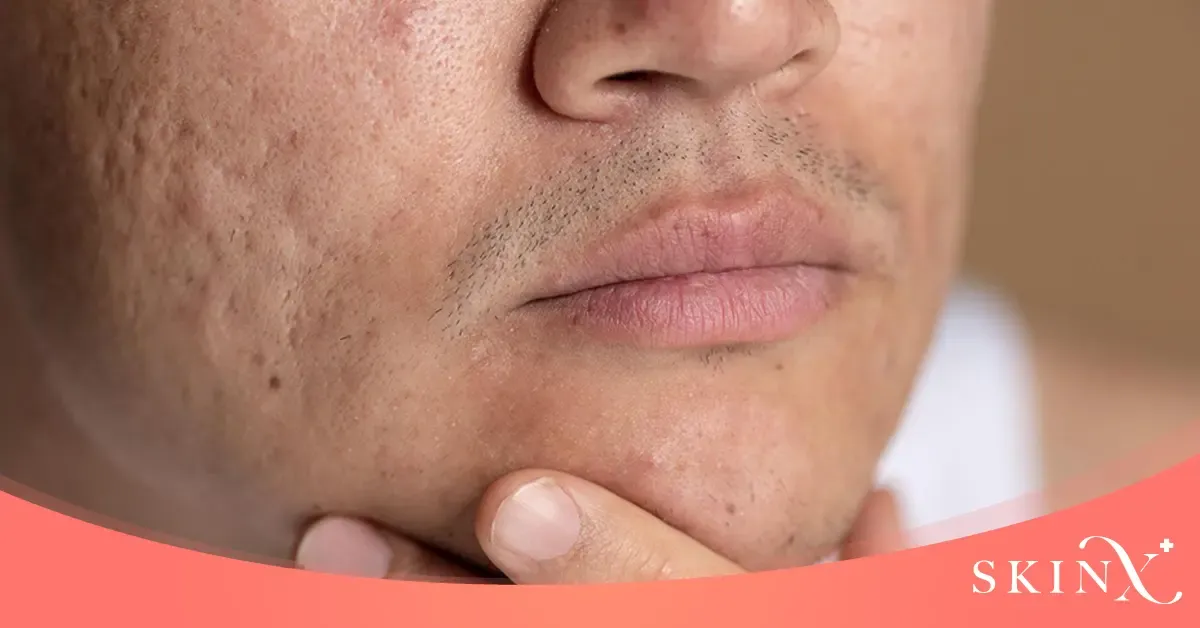 รอยหลุมสิว