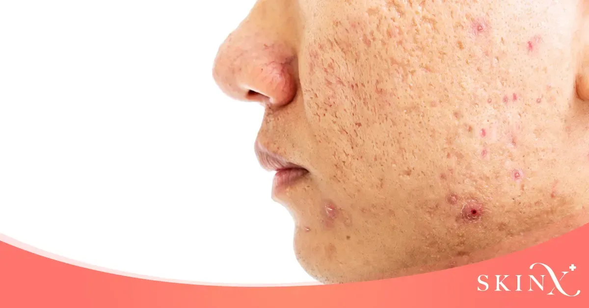 เป็นหลุมสิว