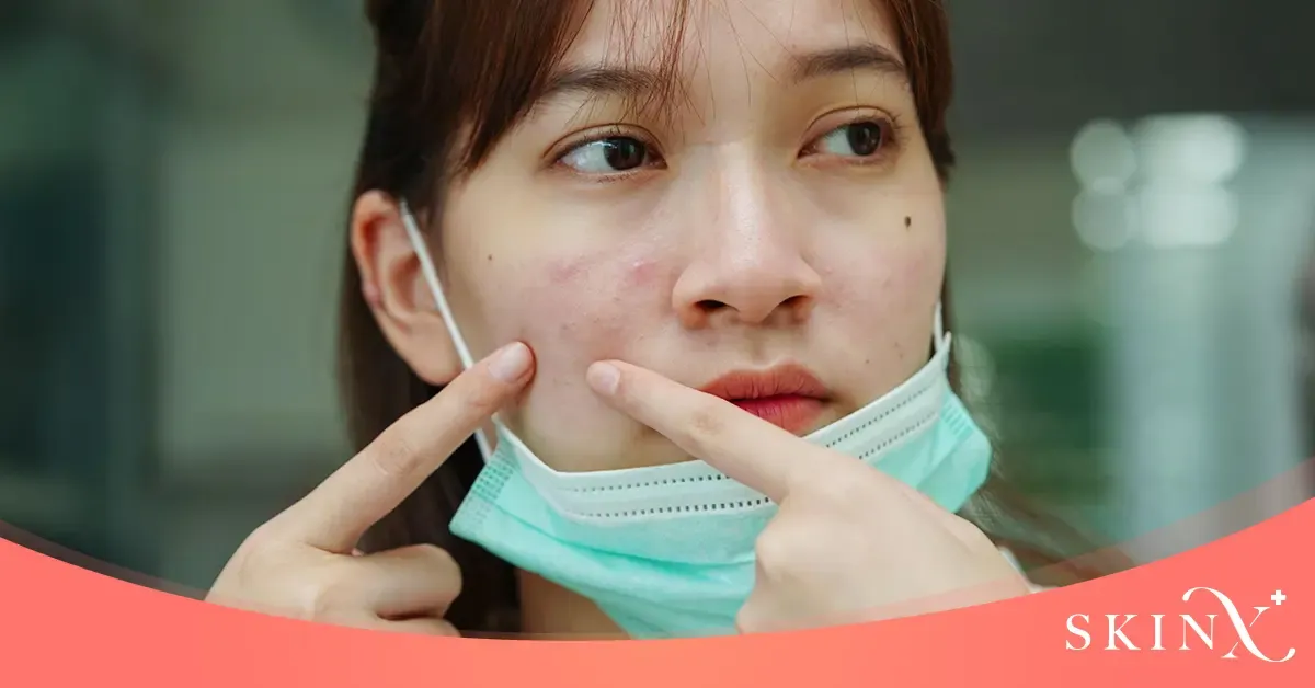 แพ้มาสก์