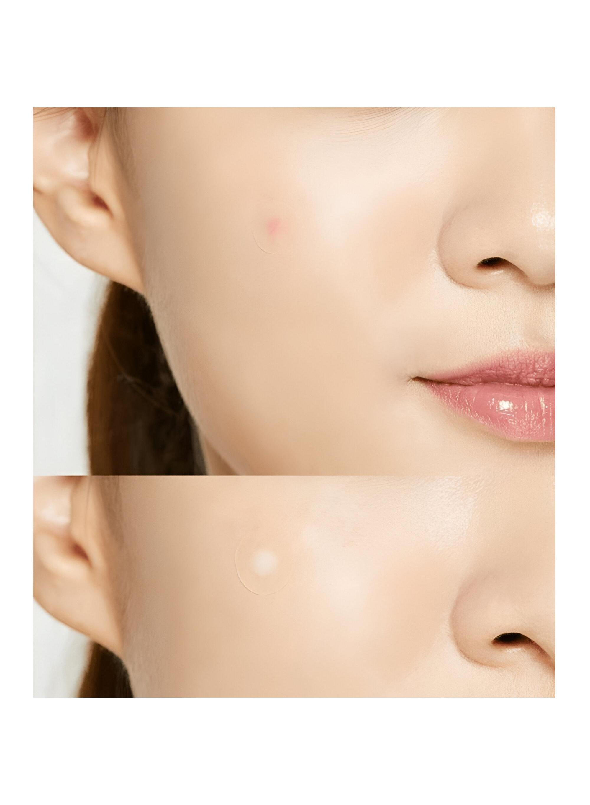 لصقات حب الشباب من كوسركس - 24 قطعة