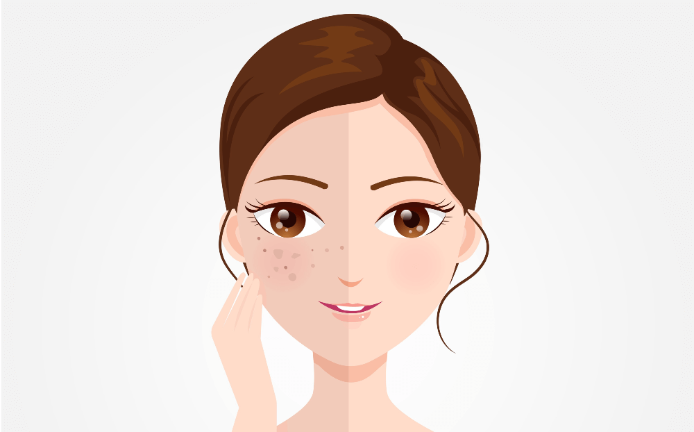 2022's Top PostAcne Dark Spot Correctors for Bright, EvenToned Skin