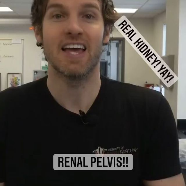 Renal pelvis, enlarged upper end of the ureter, the tube through which urine flows from the kidney to the urinary bladder. The pelvis, which is shaped somewhat like a funnel that is curved to one side, is almost completely enclosed in the deep indentation on the concave side of the kidney, the sinus. The large end of the pelvis has roughly cuplike extensions, called calyces, within the kidney—these are cavities in which urine collects before it flows on into the urinary bladder.
#renalpelvis  #kidney #kidneyanatomy #anatomy #mbbsstudent #medicinestudent #medicalhealth #housejobdiaries #housejob #plab #nle #usmle #hospital #doctorslife #doctorwho #keepgoing #motivation #influencerstyle #instagood