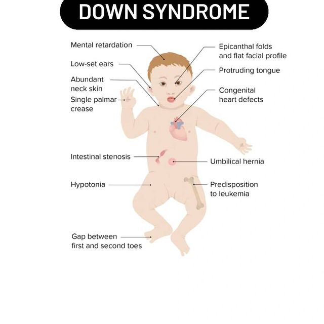 Syndromes
#downsyndrome #ptausyndrome #edwardsyndrome #turnersyndrome #instagood #doctorslife #disection #clinical #clinicalmentor #housejobdiaries #nle #plab #usmle #healthcareworkers #bishkek #bishkeklife #studynotes #studywithrija #studyabroad #mbbsdiaries