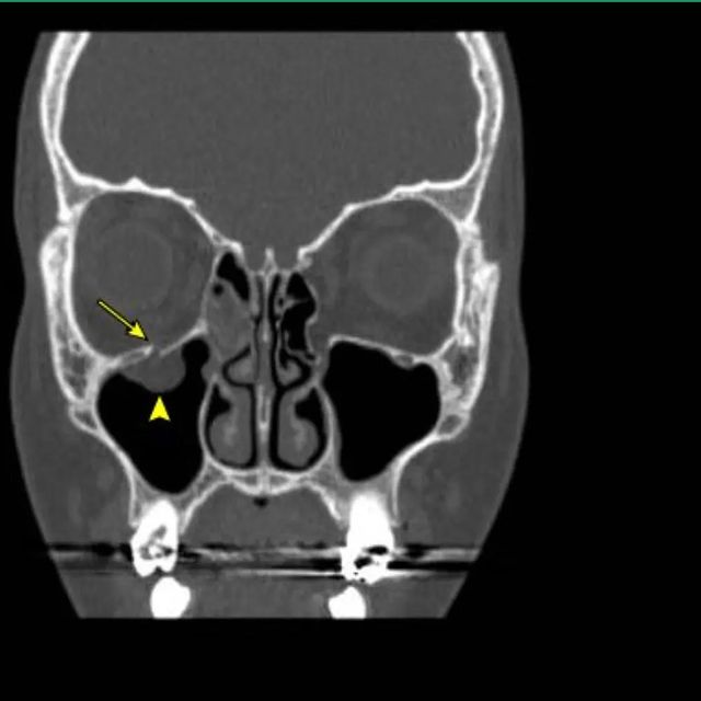 Sometimes the eye is struck so that the force of the blow is received by the eyeball and not blocked by the strong bones around the eye (as when struck by a small object such as a golf ball). In this case, the pressure on the eyeball is transmitted to the walls of the orbit. This pressure can fracture the most fragile part of the orbit, typically the part underneath the eyeball (orbital floor). This is known as a blowout fracture. Fractures can also occur to the sides (walls) and roof of the orbit. Sometimes part of the eye or the muscles attached to it is forced through the fractured bone.

A #mnemonic DECA helps you to memorize Classic Signs of Blow-Out Fracture

• Decreased upgaze (inferior rectus trapped)
• Enophthalmos
• Cheek Anesthetized (infraorbital nerve trapped).

Nosebleeds, swelling of the eyelid, and the passage of blood from ruptured blood vessels into the tissue under the skin (marked by a purple discoloration of the skin) may also occur.

If an orbital fracture is suspected, perform a CT scan, which shows any fractures, collections of blood, and displaced or trapped tissue.
Medical treatment is warranted for patients for whom surgery is not indicated. This may include patients who present without significant enophthalmos (2 mm or more), a lack of marked hypo-ophthalmic, absence of an entrapped muscle or tissue, a fracture less than 50% of the floor, or a lack of diplopia.
 

#ophthalmology #medicohubworldwide
#quick_fact #medical