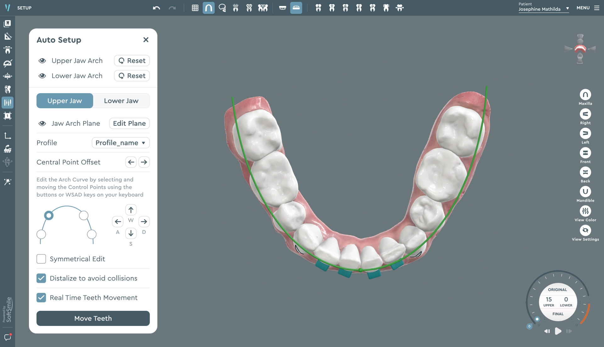 SoftSmile is orthodontic software for 3D modelling, treatment planning and crafting clear aligners