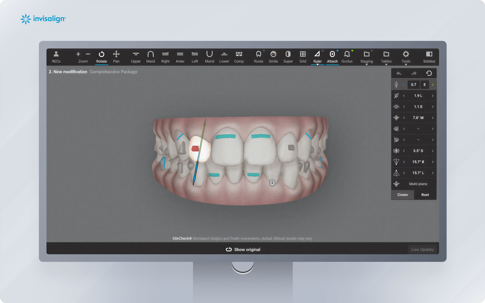 Invisalign ClinCheck