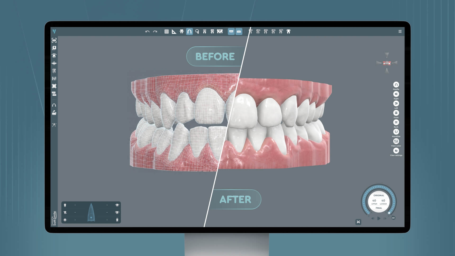 Digital diagnosis and 3D treatment simulation in orthodontic software