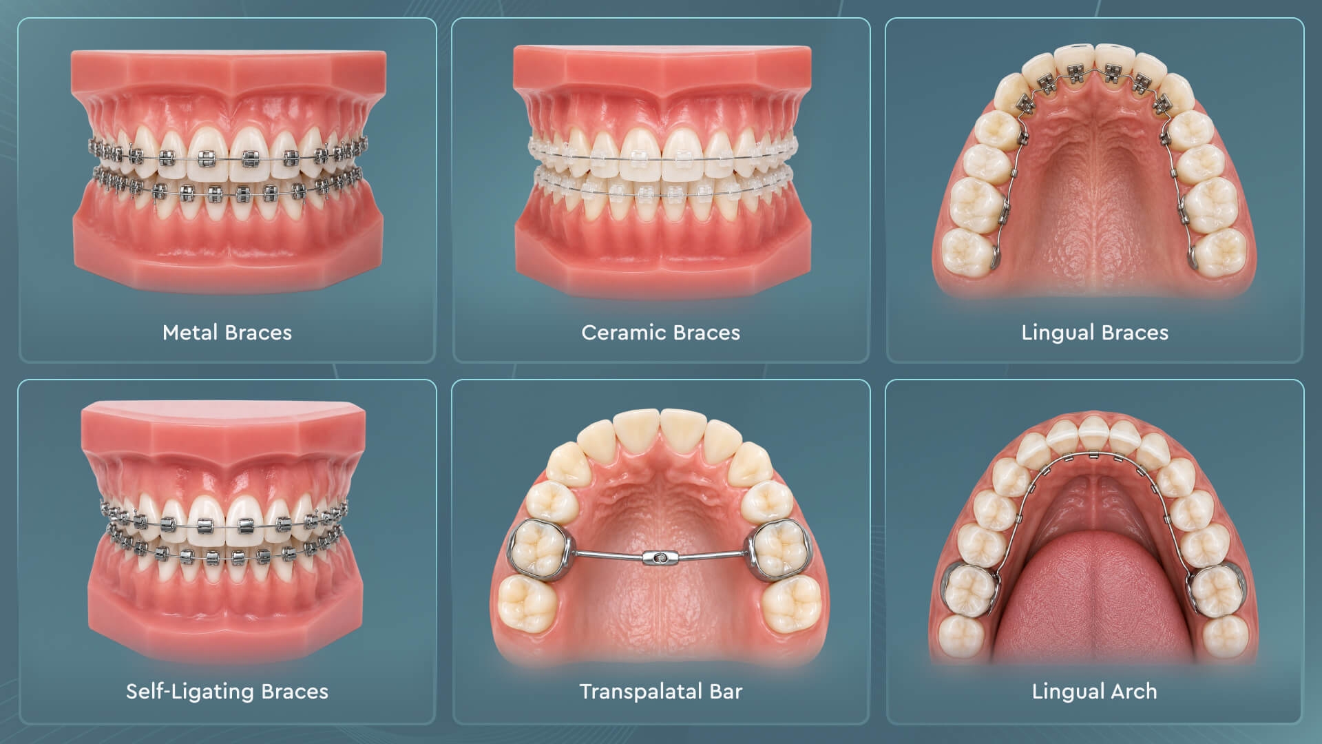 Fixed orthodontic appliances including metal braces, ceramic braces, lingual braces, and self-ligating braces