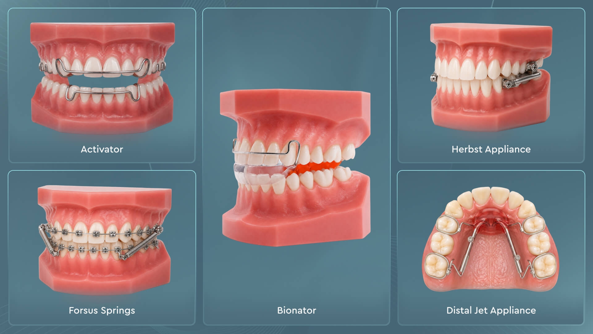 Functional orthodontic appliances including Activator, Bionator, Herbst appliance, and Forsus springs