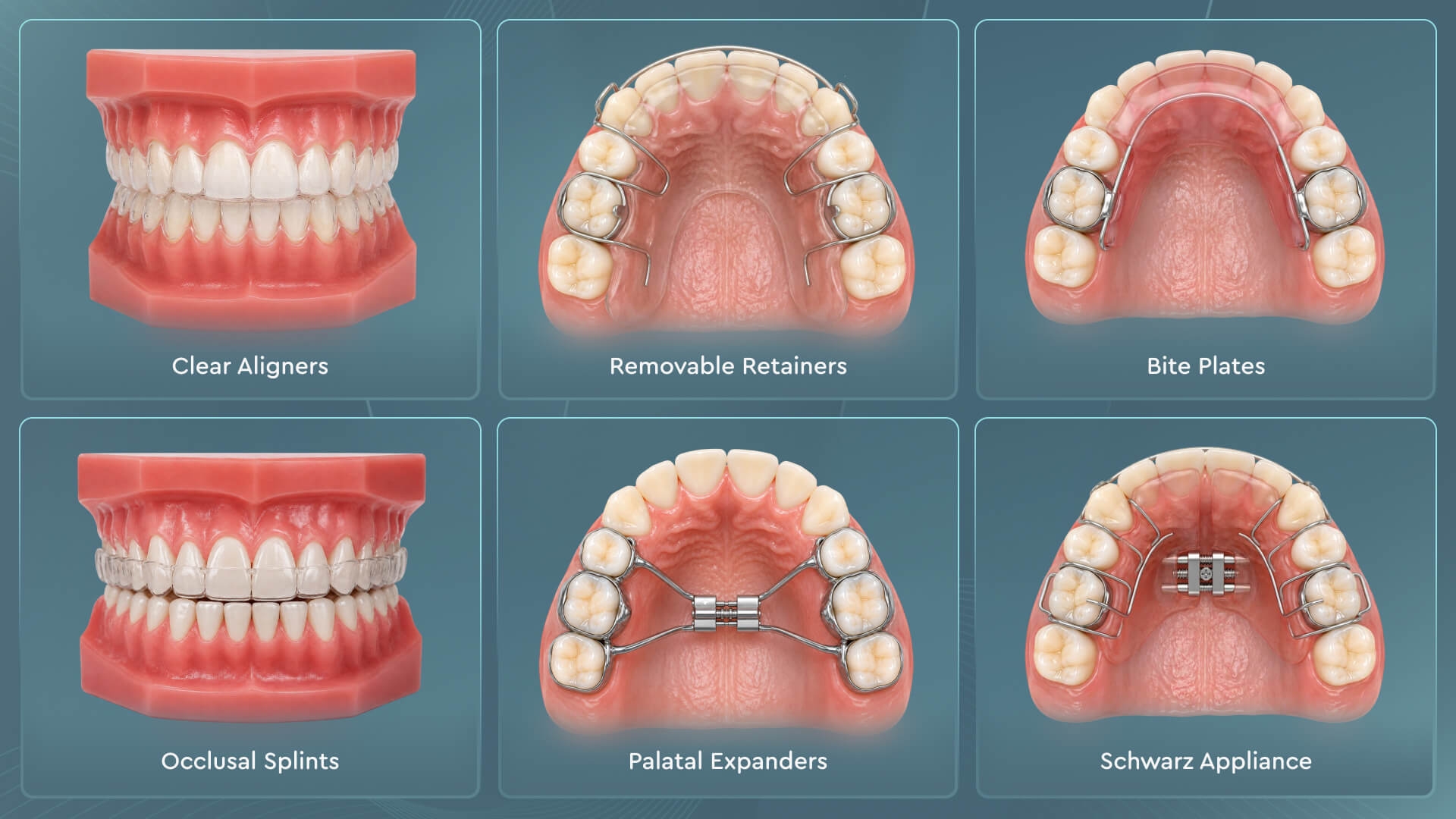 Removable orthodontic appliances including clear aligners, retainers, biteplanes, and palatal expanders