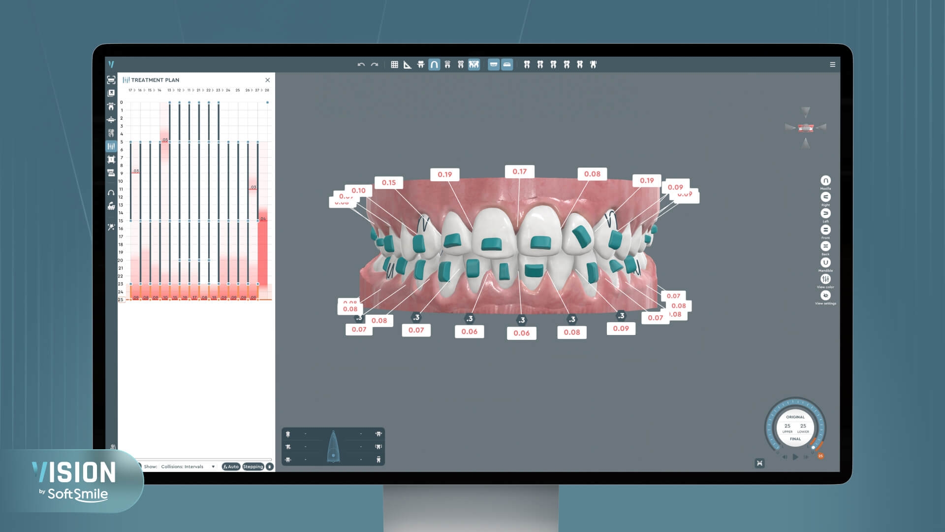 Orthodontic treatment planning software interface showing 3D dental model staging