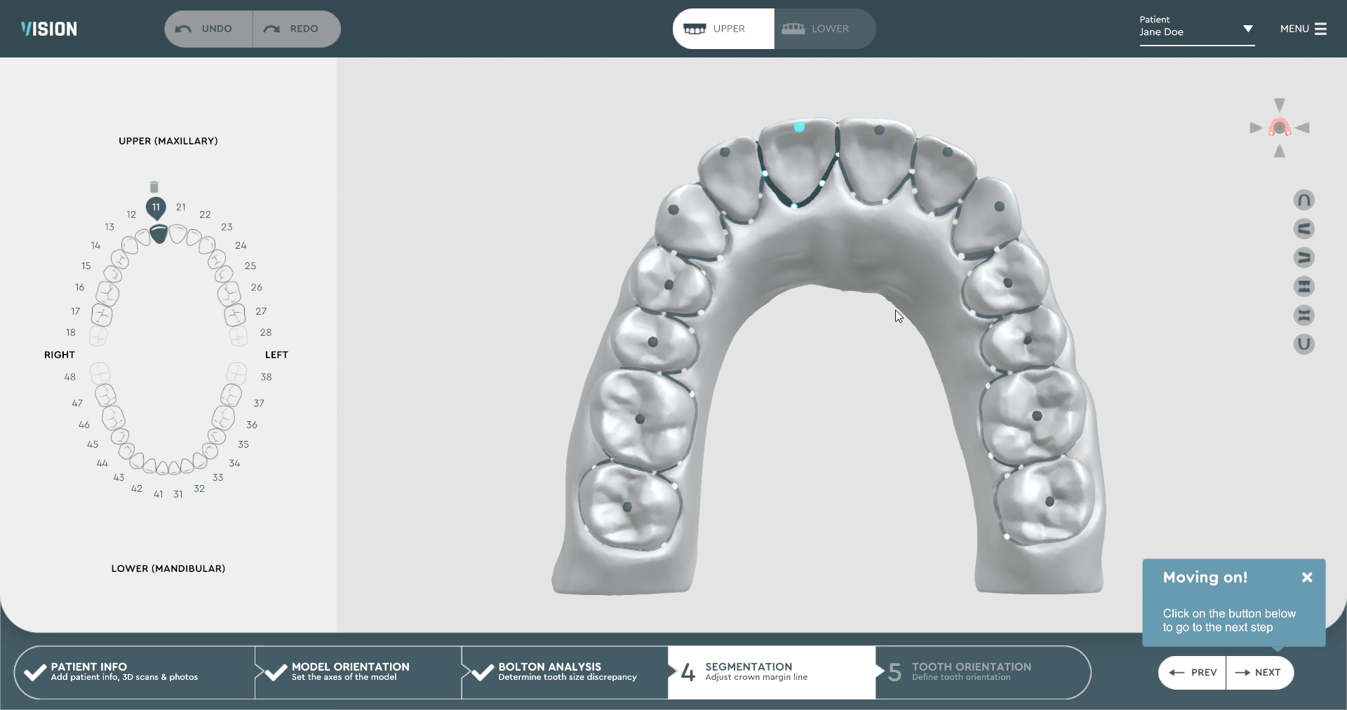 aligner treatment planning