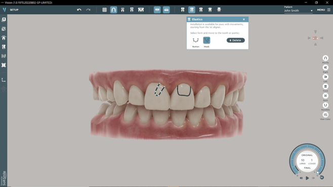 clear orthodontic aligner