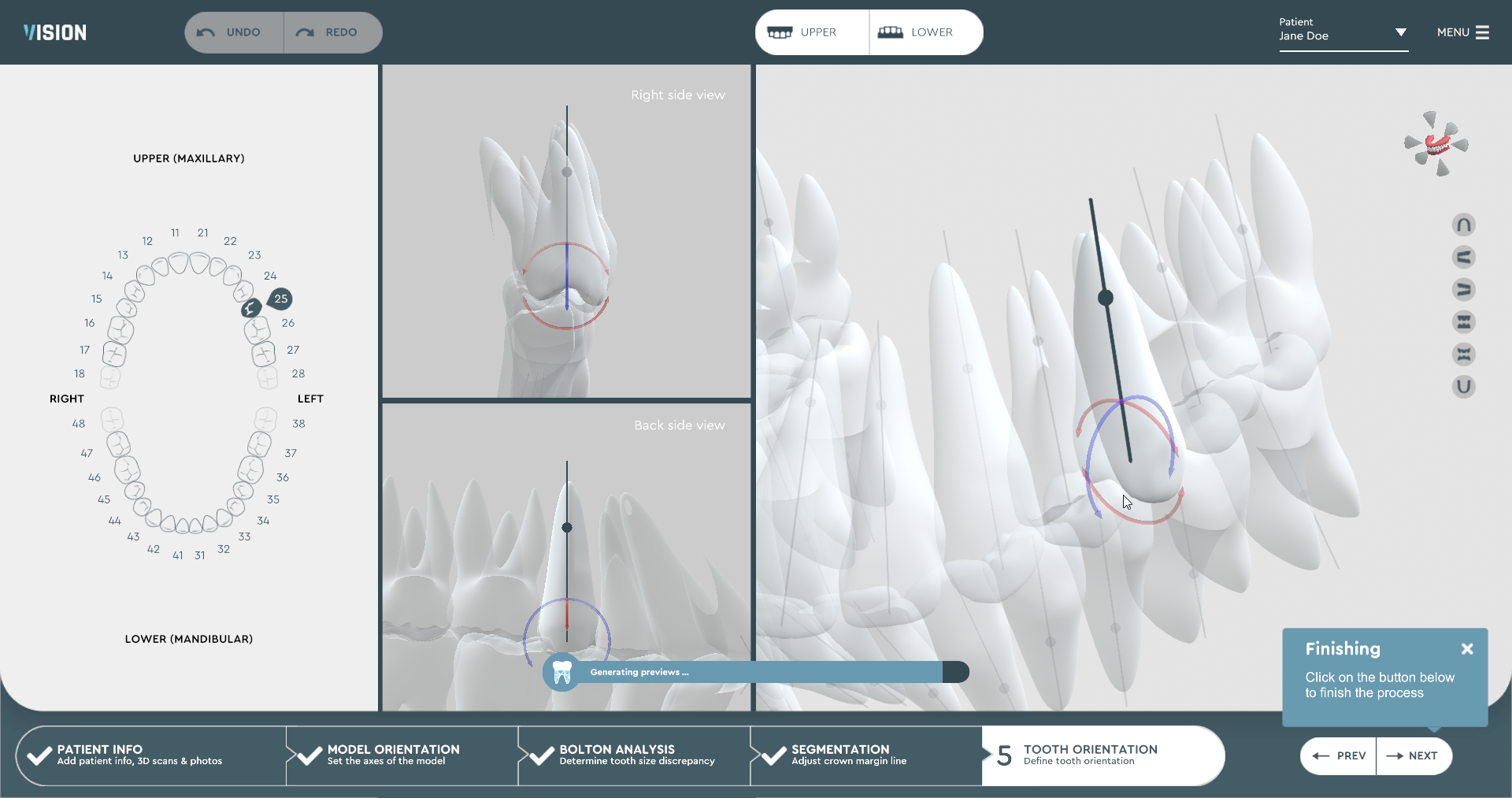 aligner treatment planning