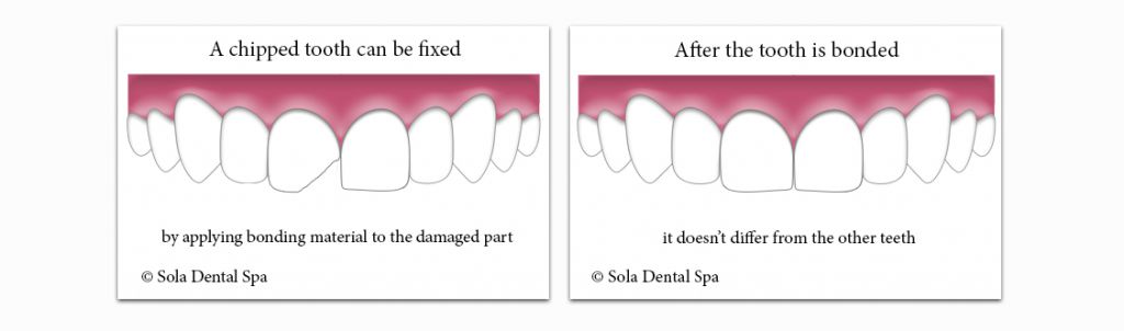 Why It Is Important to Repair a Chipped Tooth - Sandston