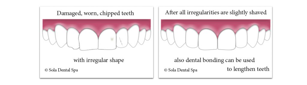 Cosmetic teeth contouring of damaged, worn teeth with spme chips