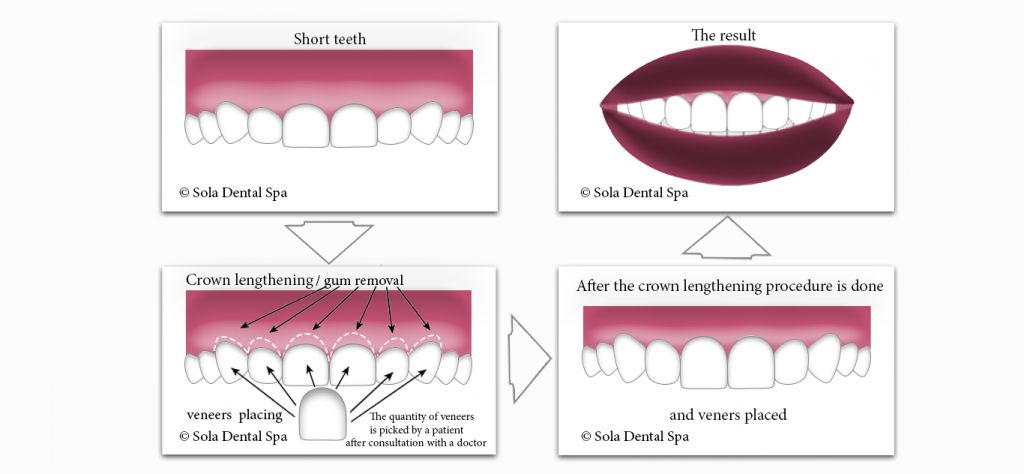 Crown lengthening Staten Island