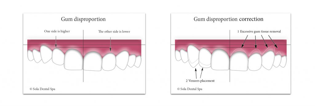 smile correction - gum disproportion correction - Sola Dental Spa