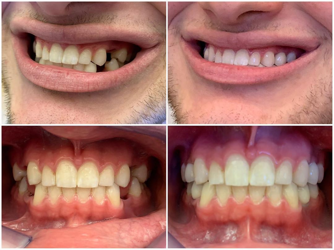 tooth implant before after