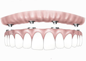 All on four dental implants / Full arch implants