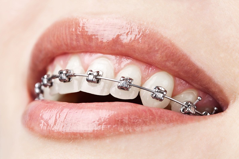 Orthodontics And Orthodontic Treatments - Sola Dental Spa dental clinic