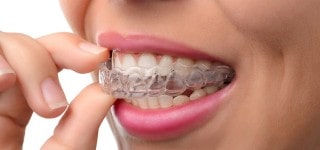 Invisalign, clear braces - alternative to metal braces - Sola Dental Spa