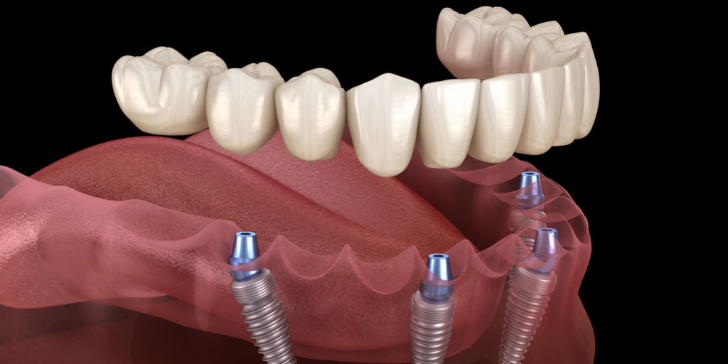 Are Same Day Dental Implants Possible Sola Dental Spa   Full Arch Dental Implants Model 