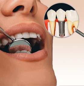 Dental Implants Staten Island