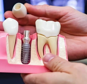 Dental implants in Staten Island - Sola Dental Spa