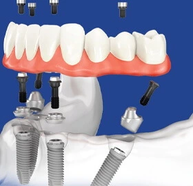 All on 4 dental Implants