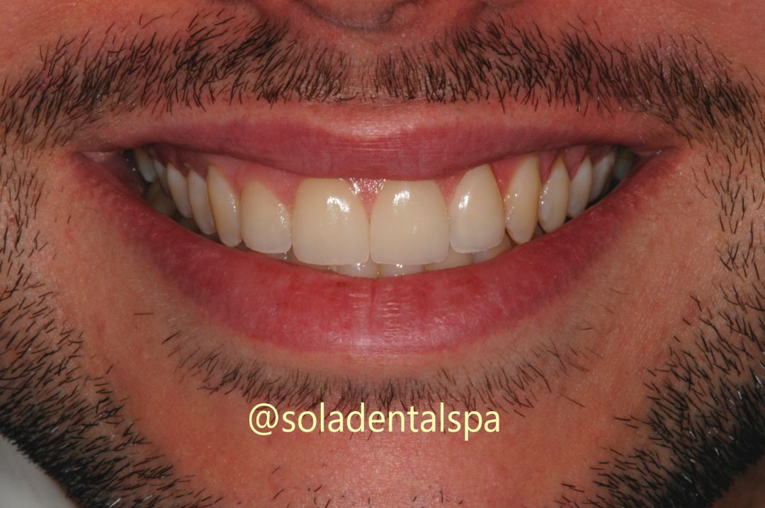 Check what are the best ways to straighten teeth - Sola Dental Spa