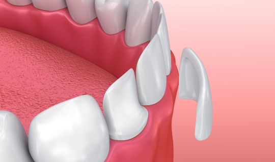 Check what are the best ways to straighten teeth - Sola Dental Spa