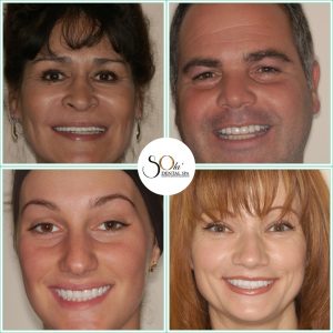 Complete smile makeover