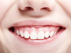 How To Fix a Gummy Smile (It's Easier Than You Think!)