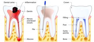 root canal treatment