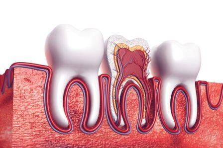 root-canal