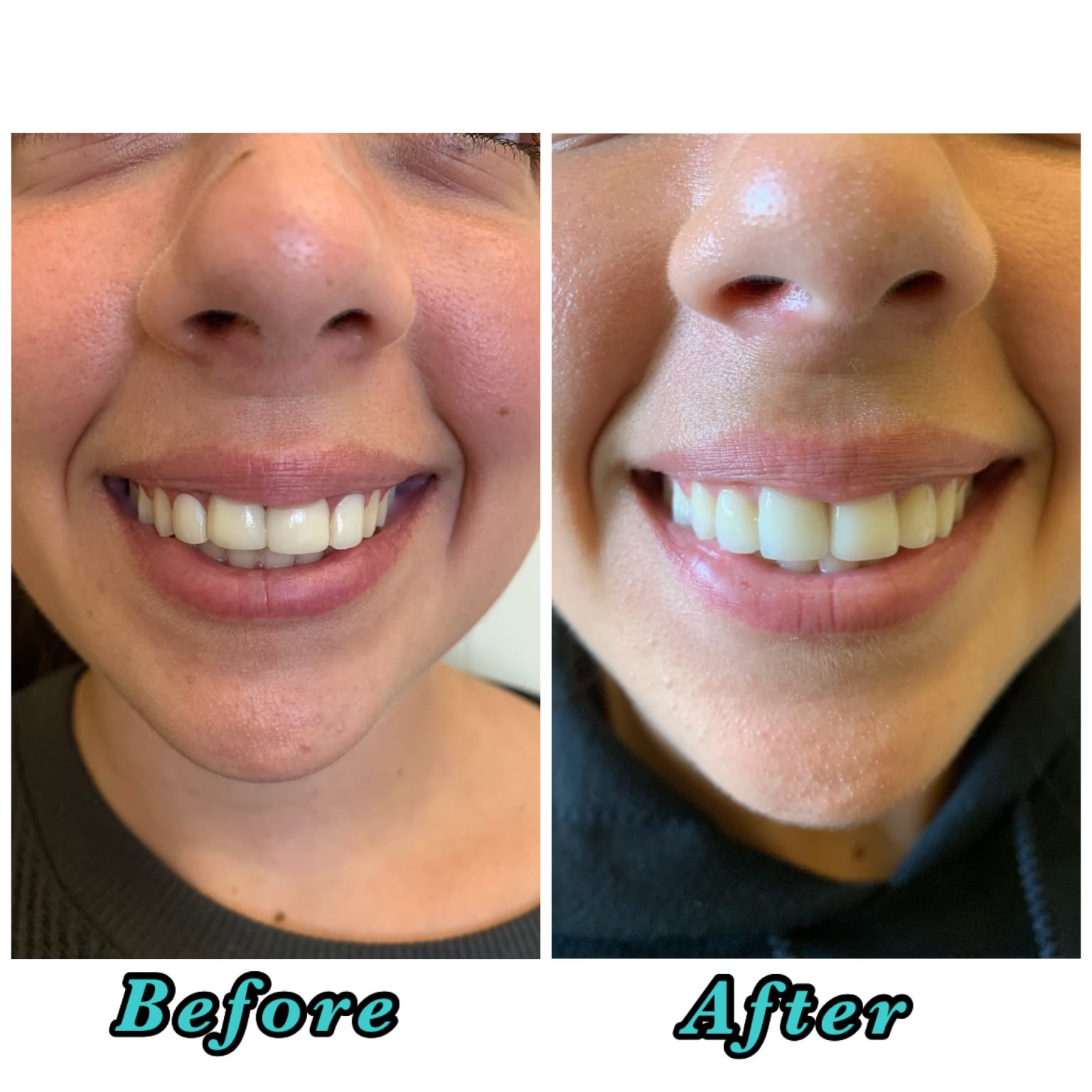 crooked teeth before and after veneers