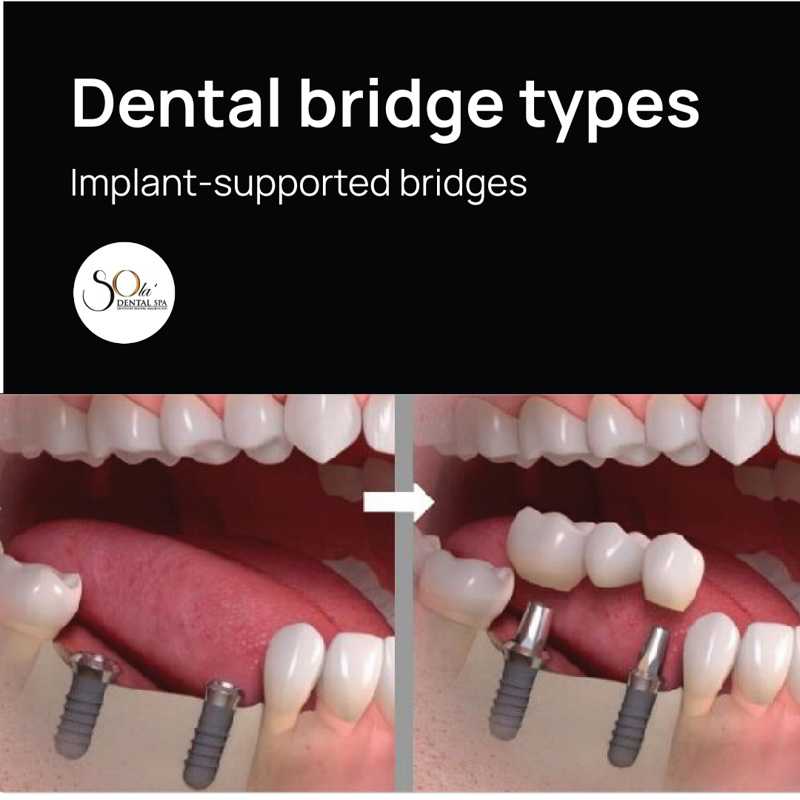 cosmetic-crown-and-bridge