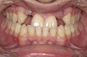 dental implant surgery