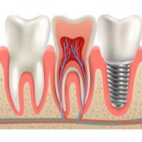 Are dental implants suitable for everyone?