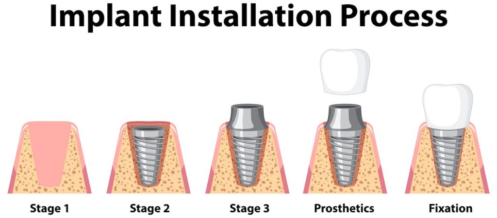 discomfort after crown placed on dental implant
