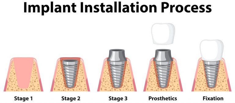 stages of implantation procedure