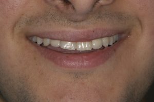 advantage of dental implants